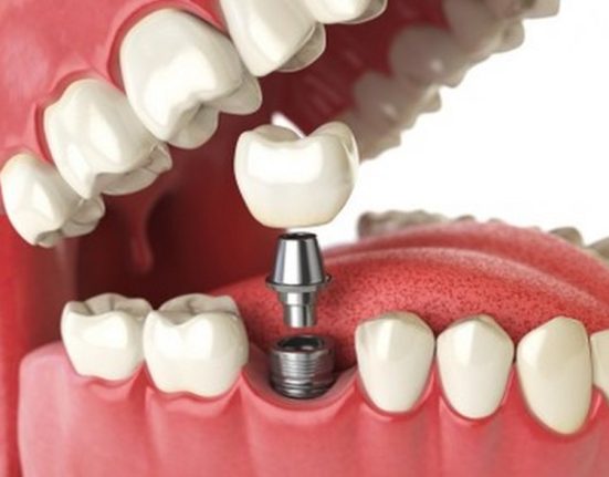 Dental Implants