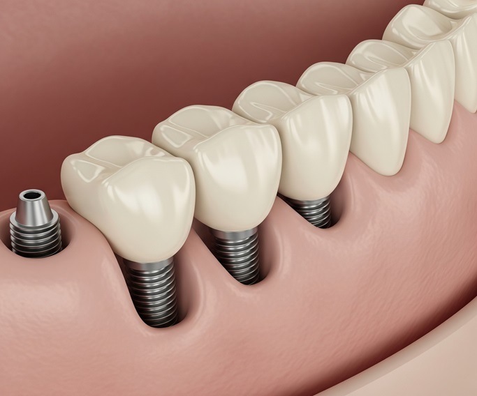 Undergoing Dental Implants